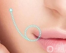 什么是嘴角上揚(yáng)手術(shù)？哪些人不適合？