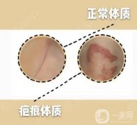 關(guān)于疤痕體質(zhì)的分類及注意事項(xiàng)？