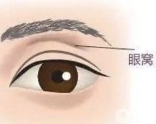 自體脂肪填充的眼窩會(huì)不會(huì)留下疤痕？填充后有什么影響？