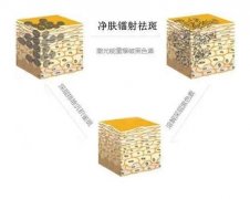鐳射凈膚有什么果？做一次要多少錢？