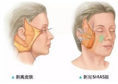 顳部懸吊術(shù)適合哪些人群？方法是怎么樣的？