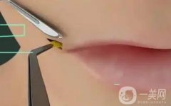 什么是嘴角上揚手術(shù)？不適合哪些人