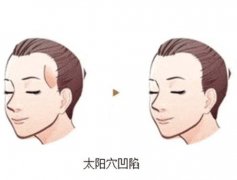 太陽穴凹陷應(yīng)該怎么辦？太陽穴凹陷有什么特點？