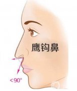 鷹鉤鼻子可以做矯正嗎?給你一些建議