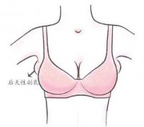 切除腋下副乳手術多少錢?價格影響因素有哪些?