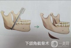 下頜角截骨后完全恢復要多久?
