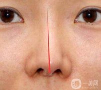 歪鼻子矯正價格要多少錢?