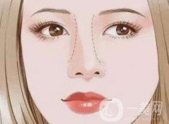 歪鼻矯正注意事項說明