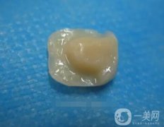什么是樹(shù)脂嵌體？樹(shù)脂嵌體有什么特點(diǎn)？
