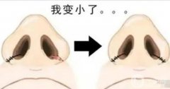 鼻翼內(nèi)切的性怎么樣？有哪些需要注意？