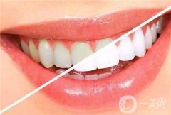 激光牙齒美白的原理是什么？適合哪些人群？