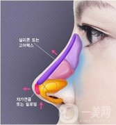 鷹鉤鼻矯正術(shù)多少錢?費用詳細解說