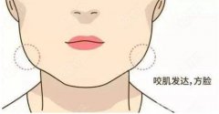咬肌切除手術(shù)多少錢?
