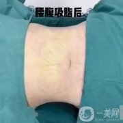 腰腹吸脂適合哪些人做?禁忌人群有哪些?