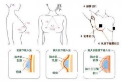 胸部整形術(shù)要多少錢?價位說明