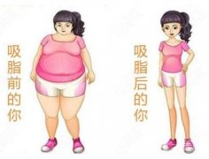 吸脂減肥嗎?有危險嗎?