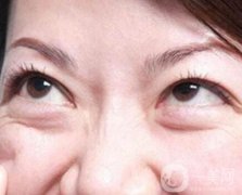 外切眼袋會(huì)留疤嗎?疤痕多久才會(huì)恢復(fù)呢?