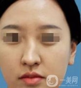 歪鼻是如何矯正的?要?jiǎng)庸穷^嗎?