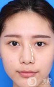 歪鼻矯正手術(shù)多少錢?多久可以出院?