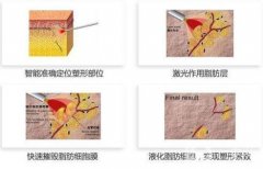 體外超聲吸脂后需要穿塑身衣嗎
