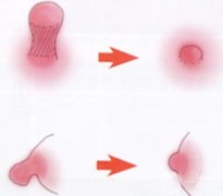 乳暈縮小手術對乳房和身體有沒有影響？怎么護理？