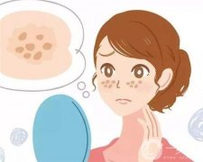 激光去痘印后如何處理抗黑？激光祛痘后的防黑是失敗的嗎？