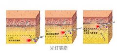 光纖溶脂腹部術(shù)后注意事項盤點