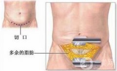 腹壁整形多少錢?費(fèi)用詳細(xì)解說