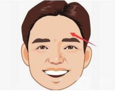 額頭不飽滿可以填充嗎?
