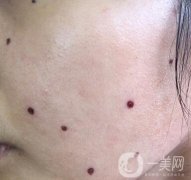 點痣后注意事項一定要遵守，否則會留疤!
