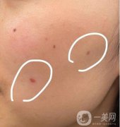 點(diǎn)痣的價(jià)格是多少?是按顆數(shù)收費(fèi)嗎?