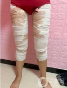 大腿部吸脂塑形術后護理