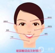 玻尿酸去法令紋能保持多久?有副作用嗎?