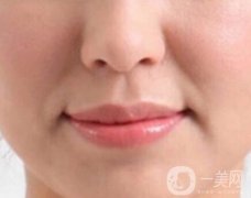 玻尿酸去法令紋多少錢?價(jià)格多少?