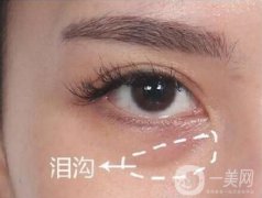 玻尿酸豐淚溝有危險(xiǎn)嗎?能管多久?
