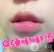 玻尿酸豐唇的果怎么樣?能維持多久?