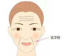 玻尿酸豐鼻唇溝果維持多久?