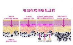 冰電波拉皮好嗎?有沒有危害?