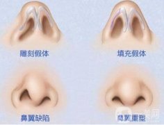 鼻翼缺損矯正大嗎?要多少錢?