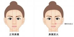 鼻翼整形手術(shù)科普,包括術(shù)前注意事項(xiàng)
