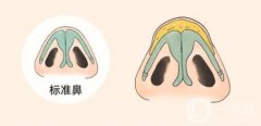 鼻頭縮小手術(shù)需要多少錢?