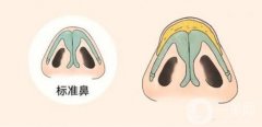 鼻頭縮小手術(shù)風(fēng)險(xiǎn)大嗎?術(shù)前要做哪些準(zhǔn)備工作?