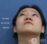 鼻頭縮小手術(shù)后遺癥有哪些?術(shù)后如何正確護(hù)理?
