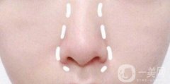 鼻頭縮小手術(shù)的費(fèi)用需要多少呢?