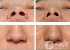 鼻孔縮小手術(shù)嗎?要多少錢?