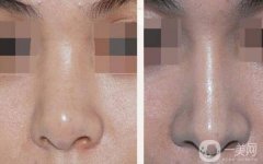 做寬鼻矯正調(diào)節(jié)果怎么樣?果保持時(shí)間多久?