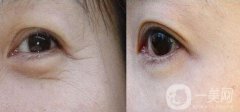 做去眼角細(xì)紋調(diào)節(jié)果怎么樣?果保持時(shí)間多久?
