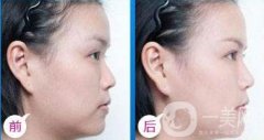 做豐耳垂失敗修復(fù)調(diào)節(jié)果怎么樣?果保持時(shí)間多久?