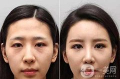 做自體脂肪去眉間紋調(diào)節(jié)果怎么樣?果保持時間多久?