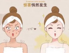 做激光后的注意事項(xiàng)有哪些呢？